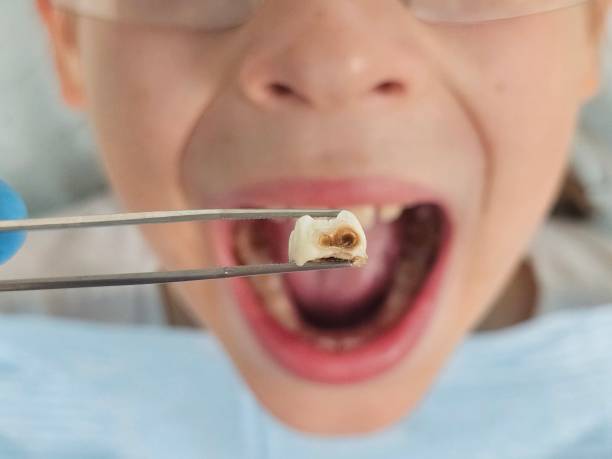 Best Emergency Dental Care for Broken or Chipped Teeth in Dadeville, AL